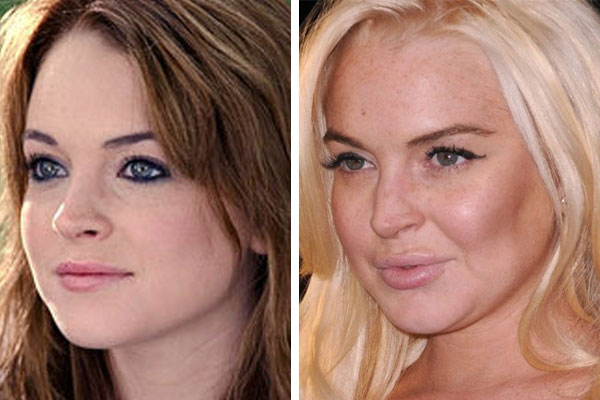 lindsay-lohan-plastic-surgery-before-and-after