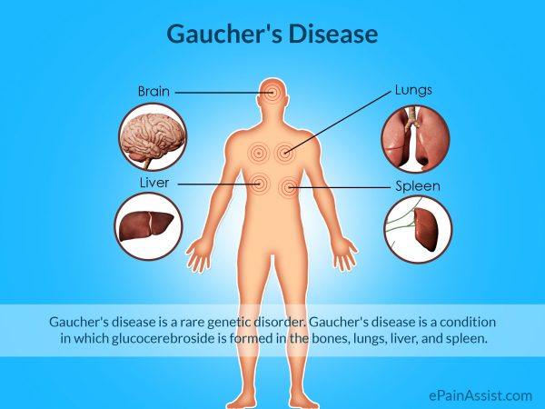 gauchers-disease