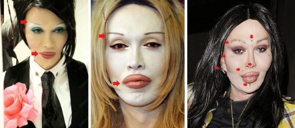 shocked-at-pete-burns-plastic-surgery-before-and-a-4
