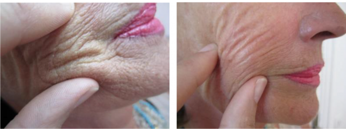 antes y despues light