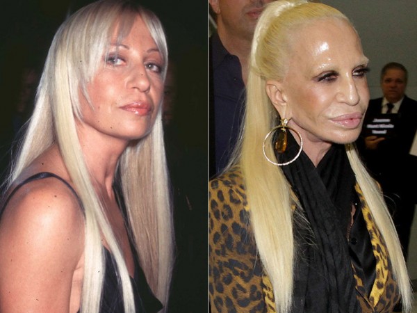 Ugly-Before-After-Donatella-Versace-Plastic-Surgery